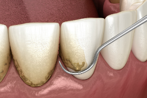 Teeth Scaling and Root Planing